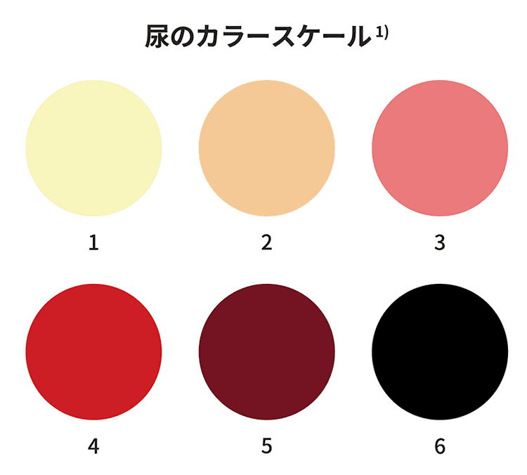 写真:典型的なPNH症例のヘモグロビン尿